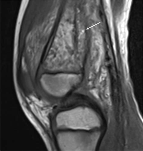 Fat Globules Sagittal T1 Weighted MR Image Of The Knee In An