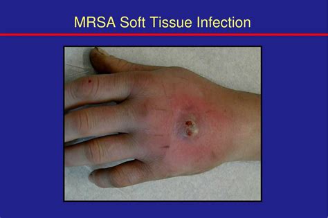 Ppt Skin Soft Tissue Infections Powerpoint Presentation Free