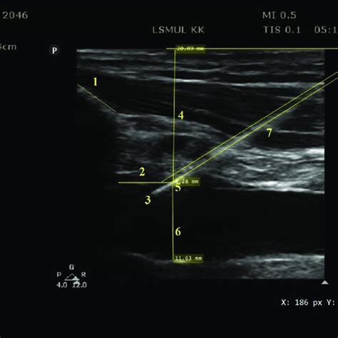 Ultrasound Image Of Infraclavicular Area Guidewire Subclavian And