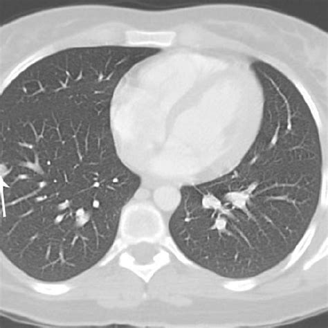 Chest Computed Tomography Demonstrating Multiple Discrete Pulmonary