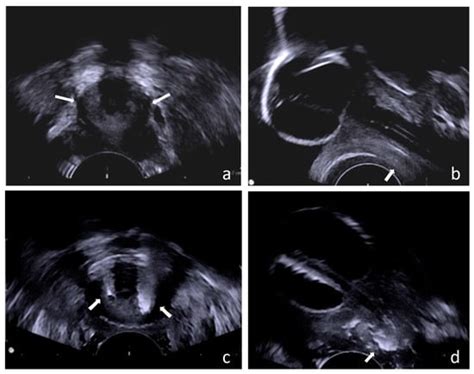 Toxins Free Full Text The Efficacy Of Transvaginal Ultrasound Guided Bont A External