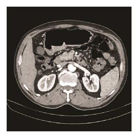 Initial Abdominal Computed Tomography Scan A~c And Follow Up Scan