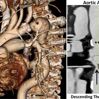 Left Computed Tomography Angiogram CTA With 3D Reconstruction Of