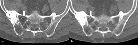 Ultra Low Dose Whole Body Ct For Attenuation Correction In A Dual