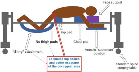 Scheme Depicting The Prone Position Of The Patient To Perform Download Scientific Diagram