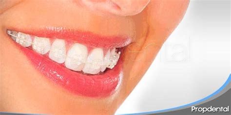 Ventajas De Los Brackets De Porcelana En Barcelona Y Madrid