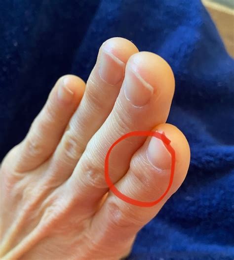 What Is A Bone Spur In Your Thumb At Coleman Stevens Blog