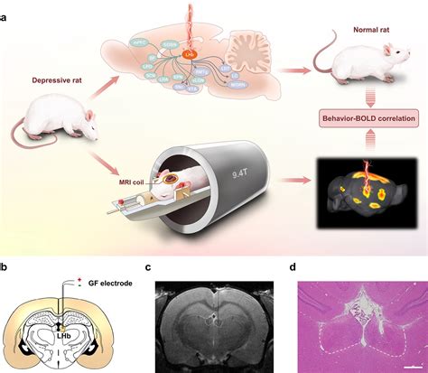 Instantaneous Antidepressant Effect Of Lateral Habenula Deep Brain