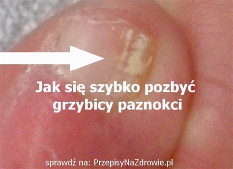 Przepisynazdrowie Pl Jak Szybko Wyleczyc Grzybice Paznokci