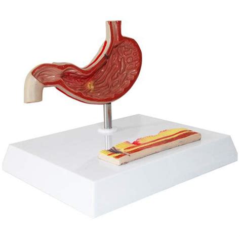 Buy Stomach Pathologic Peptic Ulcer Human Digestive System Organ