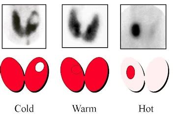 Solitary Thyroid Nodule - Endocrine - Medbullets Step 1