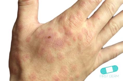 Erythema Multiforme Minor Hand