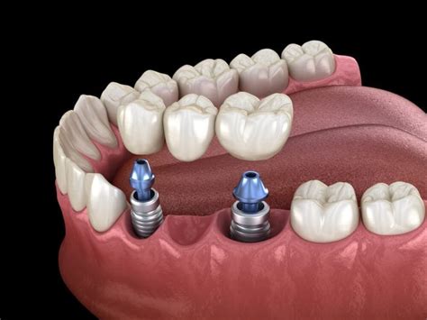 Puente Sobre Implantes Dentales Para Qu Sirve Ventajas Y M S