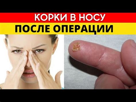 Корки в носу после операции - YouTube