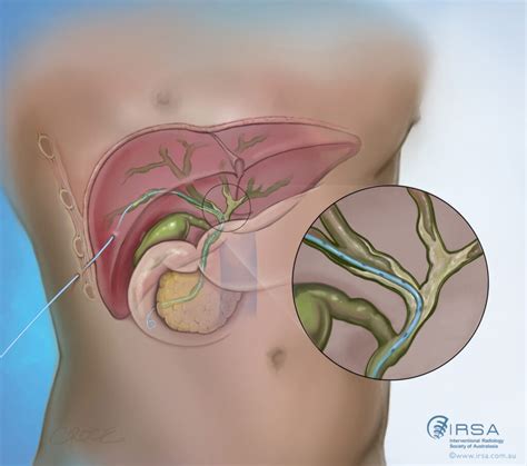 Biliary Drainage And Stenting Interventional Radiology Treatment