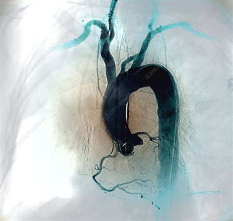Aortic arch, X-ray - Stock Image - C029/9959 - Science Photo Library