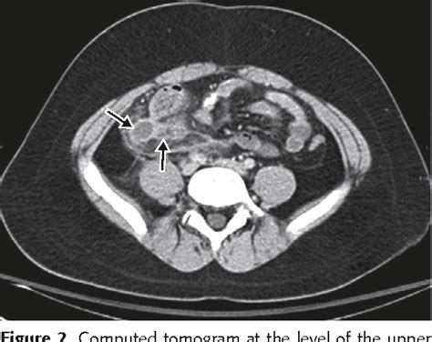 Figure 2 From Ileocecal Burkitt S Lymphoma Presenting As Ileocolic