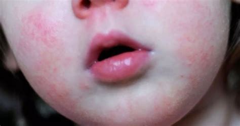 Scarlet Fever Cases Rise Week On Week Across Berkshire According To