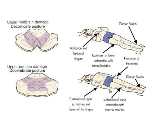 Remember.. decorticate is flexion of upper extremities inward toward ...