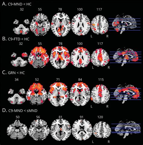 Patterns Of Gray Matter GM Atrophy In Patients With Frontotemporal