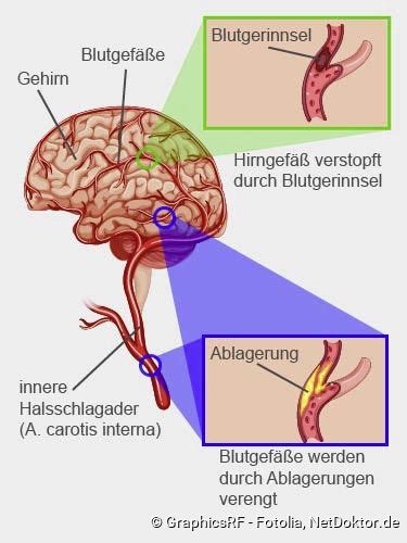 Schlaganfall Apoplex Warnzeichen Ursachen Therapie Netdoktor