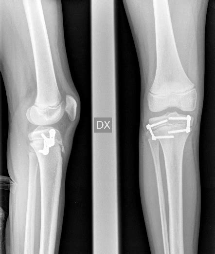 Leg Lenght Discrepancy Prof Nicola Portinaro Orthopedic Suregon