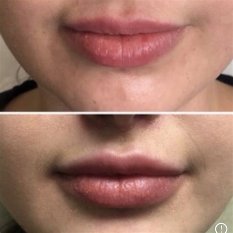 Juvederm Lumps Lips Lipstutorial Org