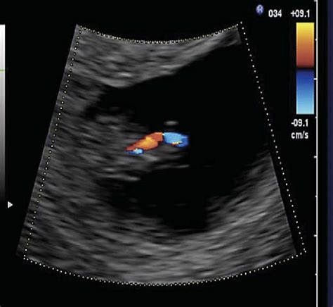 Transvaginal Color Doppler Imaging Of A Single Large Vessel Entering