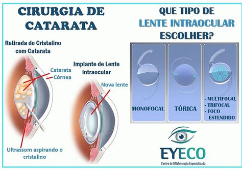 Cirurgia De Catarata Preparo E Escolha Das Lentes Intraoculares