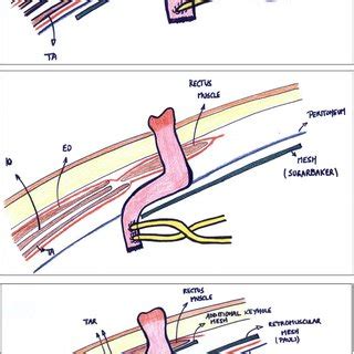 Absence Of Peritoneum Below The Arcuate Line After Radical Cystectomy