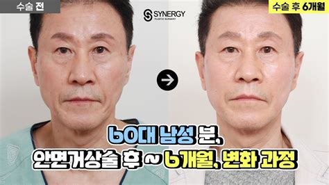 얼굴처짐and주름이 많았던 60대 남성 분의 【안면거상후기 → 6개월 간의 변화】과정 영상으로 확인해 보세요👀 Youtube