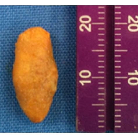 Clinical view of the sialolith after surgical removal. | Download ...