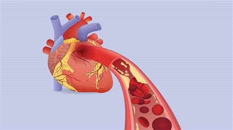 Heart Attack Causes and Risk Factors | Christ Memorial