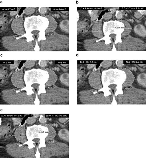 Five Methods Used To Assess Muscle Mass And Quality On Preoperative Ct