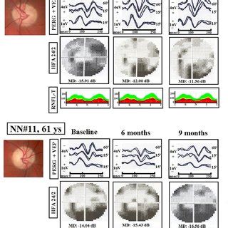 Examples Of Simultaneous Visual Evoked Potentials VEP And Pattern