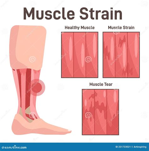 Leg Muscle Injury Muscle Strain At Different Stages Healthy Strained