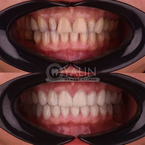 E Max Laminate Veneers In Turkey Antalya