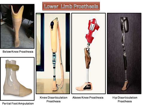 Lower Limb Prosthesis From Creative Orthotic And Prosthetic Solutions