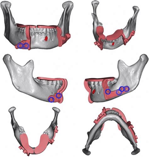 Fibular Reconstruction Of The Maxilla And Mandible With Immediate