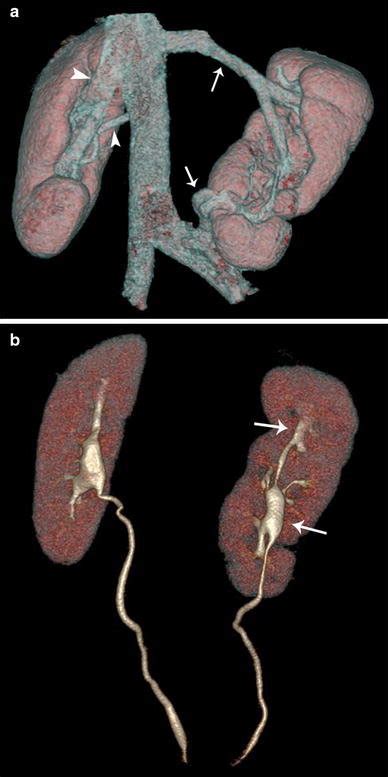 3D Volume Rendering Technique VRT Image Reconstructed By The Venous