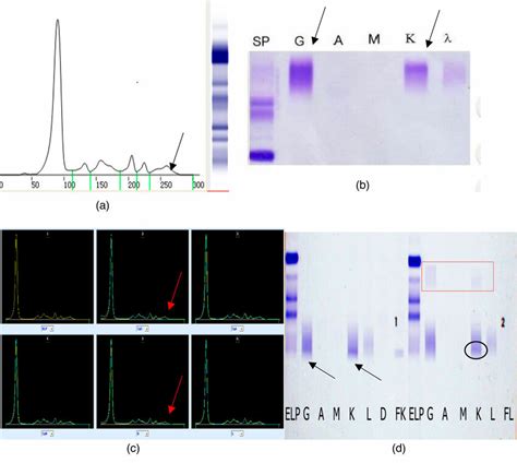 The Results Of Serum Protein Electrophoresis Immunofixation