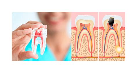 Endodoncia Tratamiento Que Puede Salvar Nuestro Diente O Muela