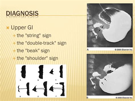 Pyloric Stenosis Shoulder Sign