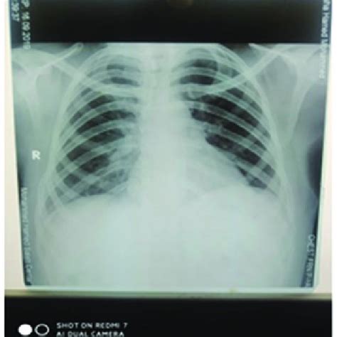 Chest X Ray Showed Increased Cardiothoracic Ratio Download Scientific Diagram