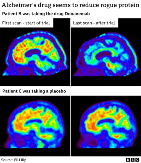 Drug Donanemab Seen As Turning Point In Dementia Fight Bbc News