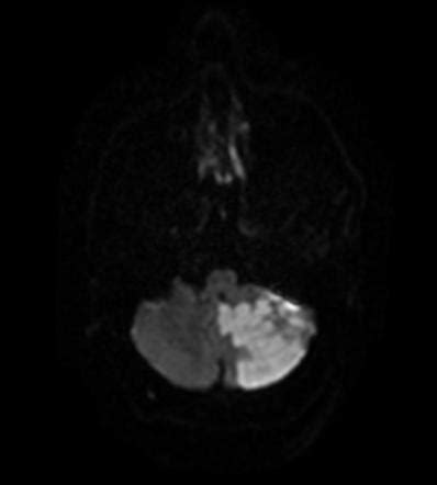 Posterior Inferior Cerebellar Artery Pica Infarct Radiology Case