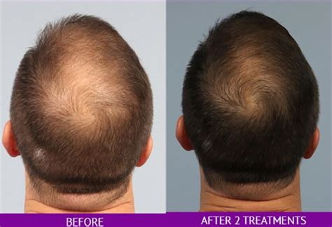 Hair Restoration Before After Photos Patient 24 Washington DC MI