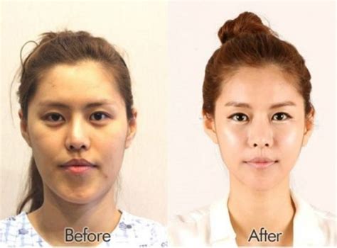 Crazy Before And After Photos Of South Korean Plastic Surgery