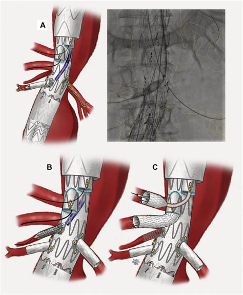 A Sequential Vessel Stenting B With An Intra Aortic Stent Flaring Download Scientific