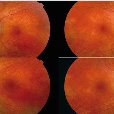 Color Fundus Photograph Of The Left Eye A And Right Eye B Showing